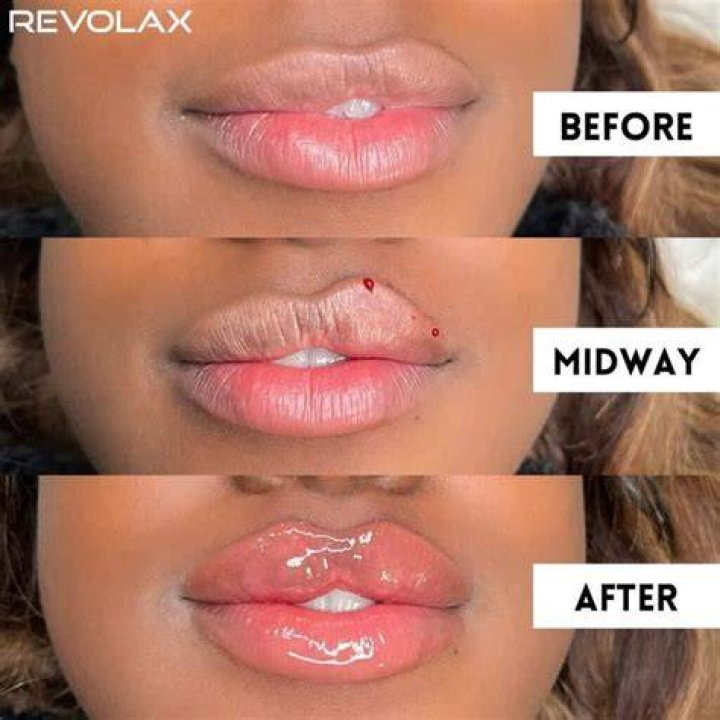 A Deep Dive Into Lip Fillers